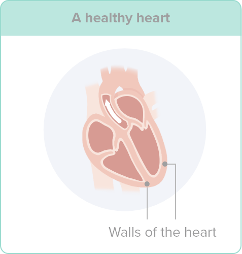 An illustration of a healthy heart, pointing out the healthy walls of the heart