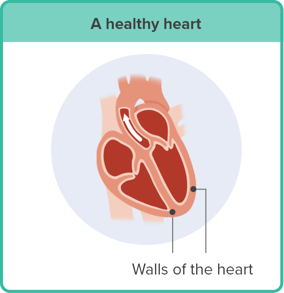 An illustration of a healthy heart, pointing out the healthy walls of the heart