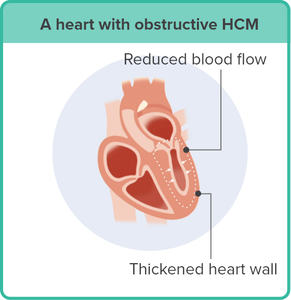 An illustration of a heart with obstructive hypertrophic cardiomyopathy (HCM), pointing out the thickened heart wall and reduced blood flow