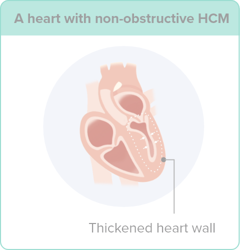 An illustration of a heart with non-obstructive hypertrophic cardiomyopathy (HCM), pointing out the thickened heart wall