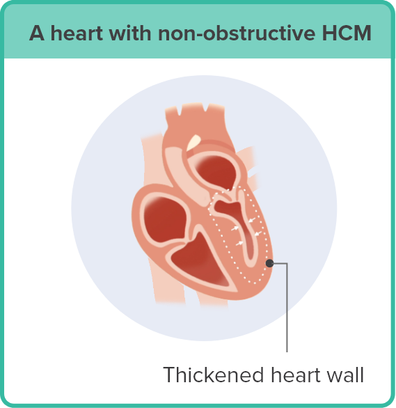 An illustration of a heart with non-obstructive hypertrophic cardiomyopathy (HCM), pointing out the thickened heart wall