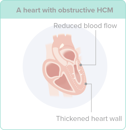 An illustration of a heart with obstructive hypertrophic cardiomyopathy (HCM), pointing out the thickened heart wall and reduced blood flow